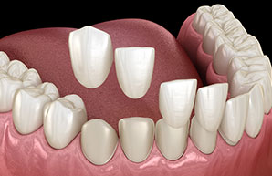 e-max veneers