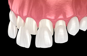 composite ceramic veneers